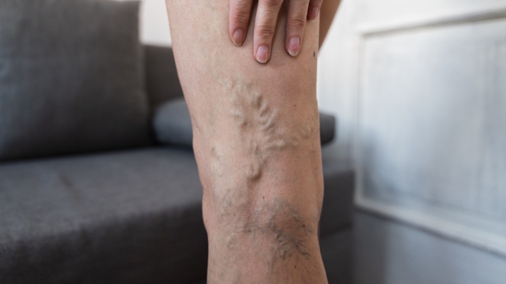 A close up of varicose veins, which can be treated with witch hazel