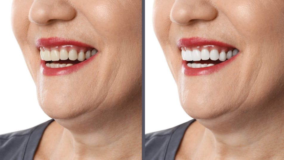 mature woman close up on teeth, temporary color concept