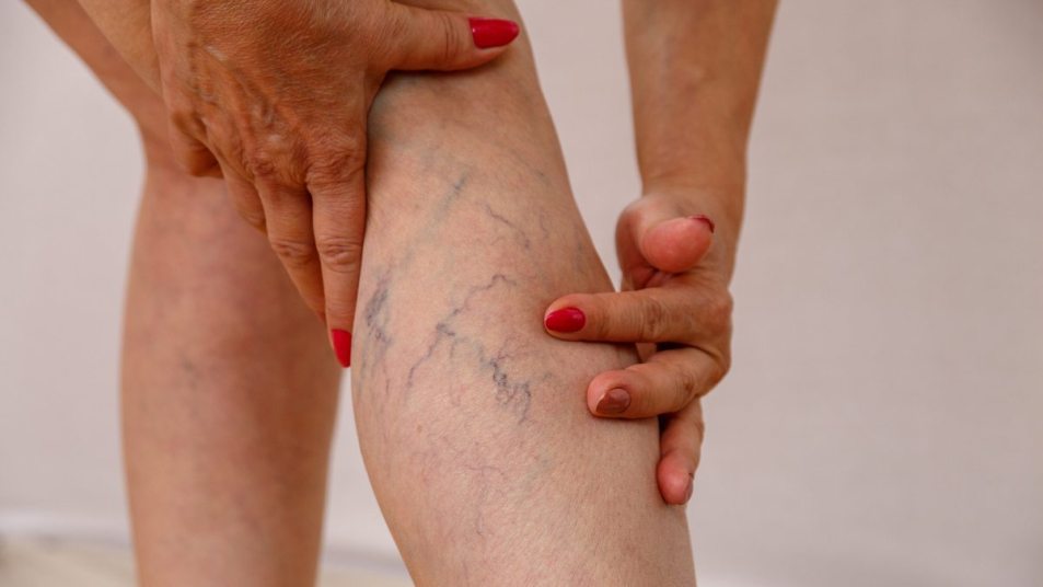 close up of senior woman holding leg with veins, concept for deep vein thrombosis