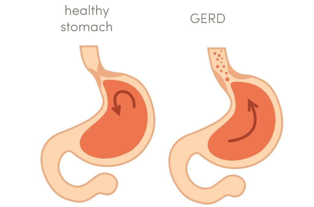 An illustration of heartburn or acid reflux