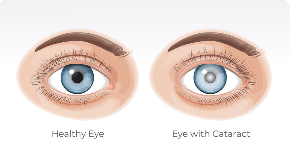 illustration of cataracts, a condition marigold extract can heal