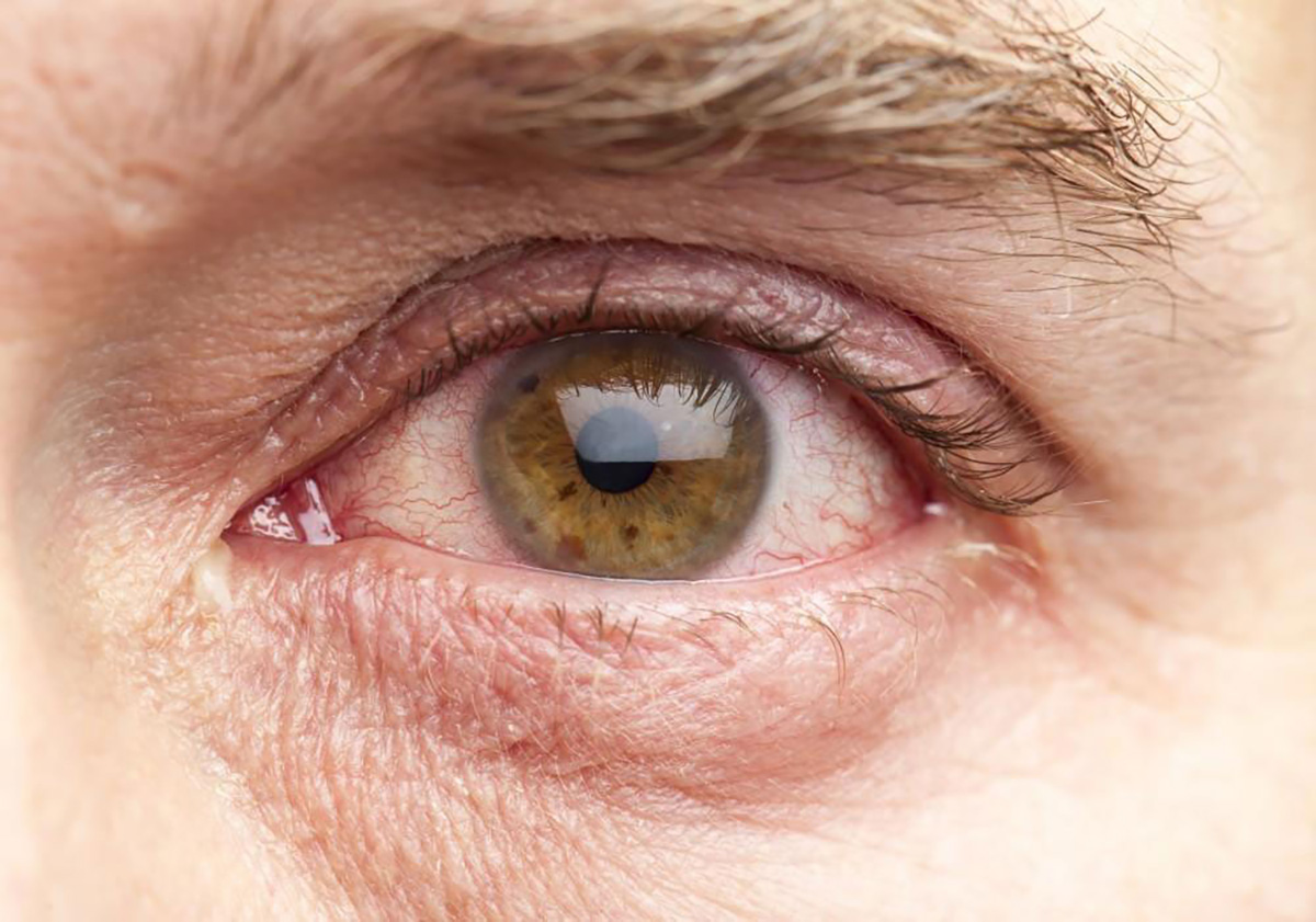 Dry Eye