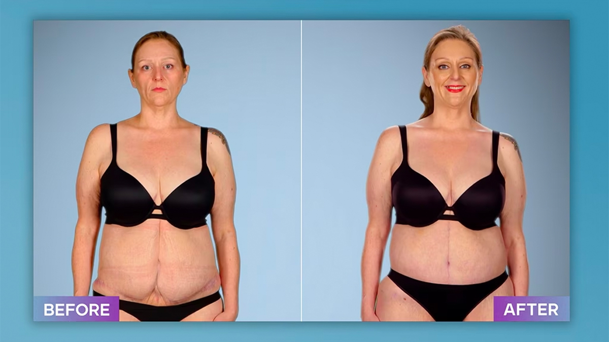 Terina, tummy tick before and after