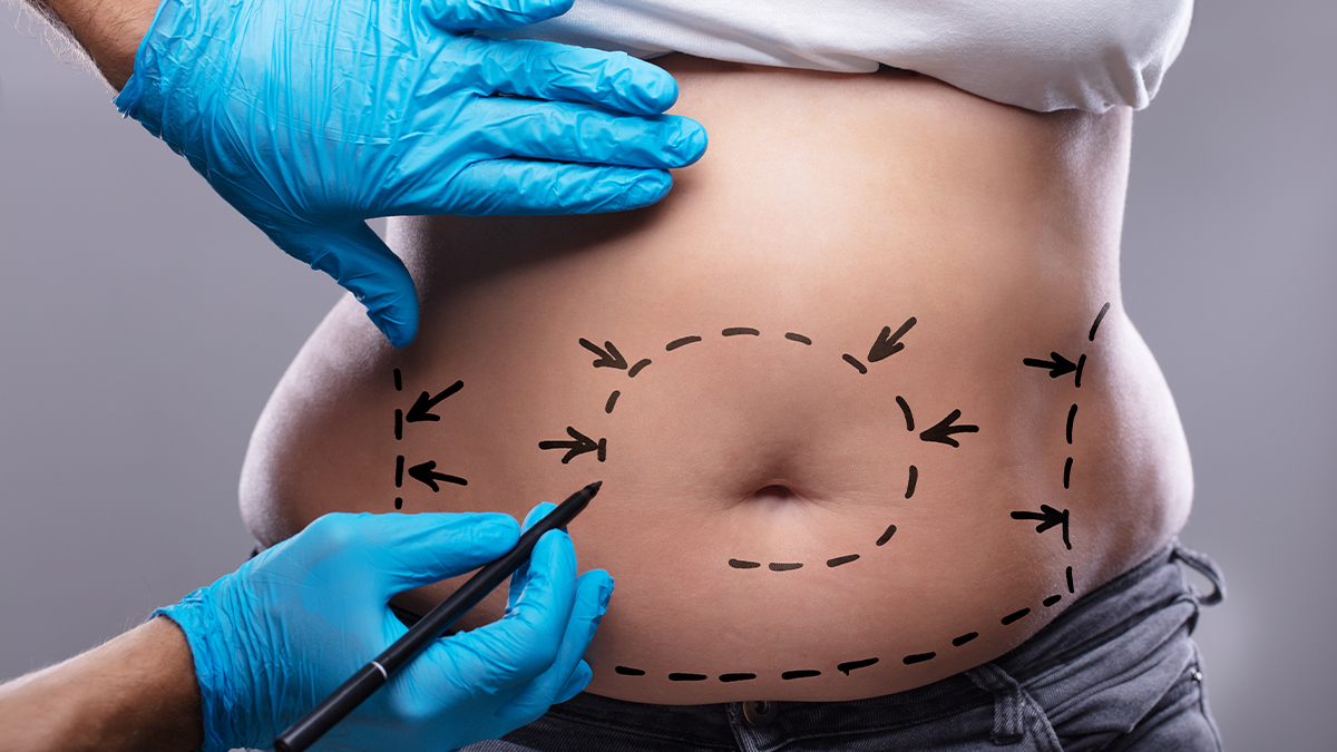 surgeon drawing lines on tummy before a tummy tuck