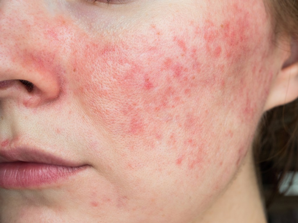 close up of rosacea on woman's cheek