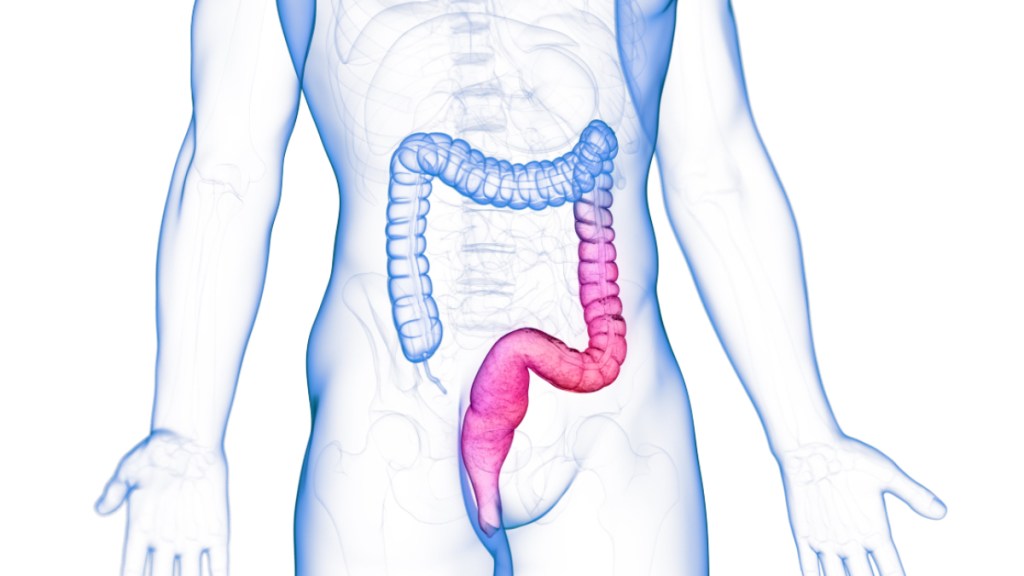 An illustration of ulcerative colitis, a form of IBD