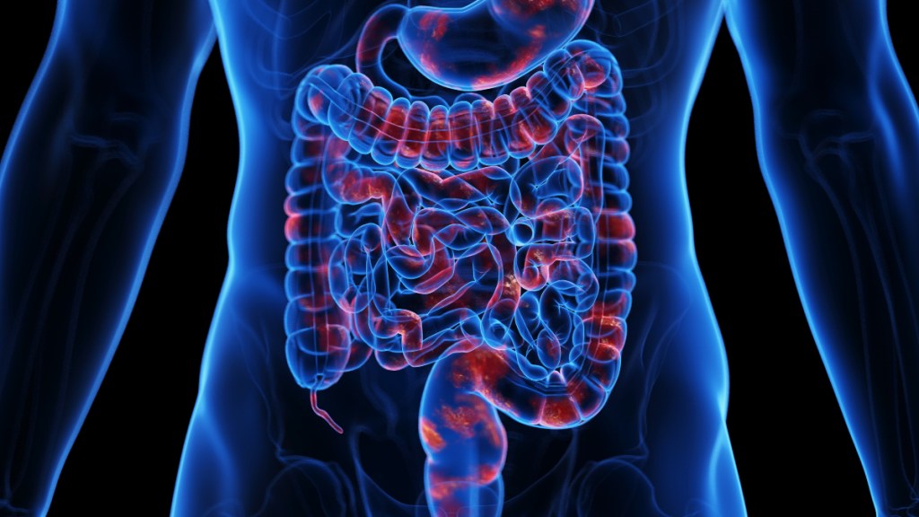 An illustration of Crohn's disease, a form of IBD