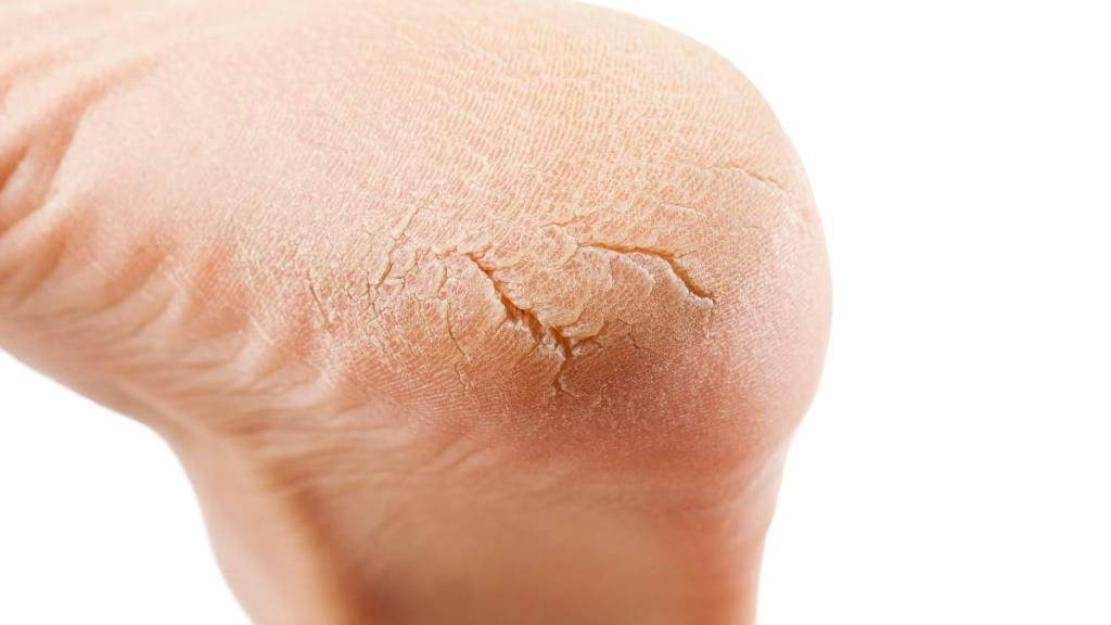 A close-up image of painful cracked heels, also known as heel fissures