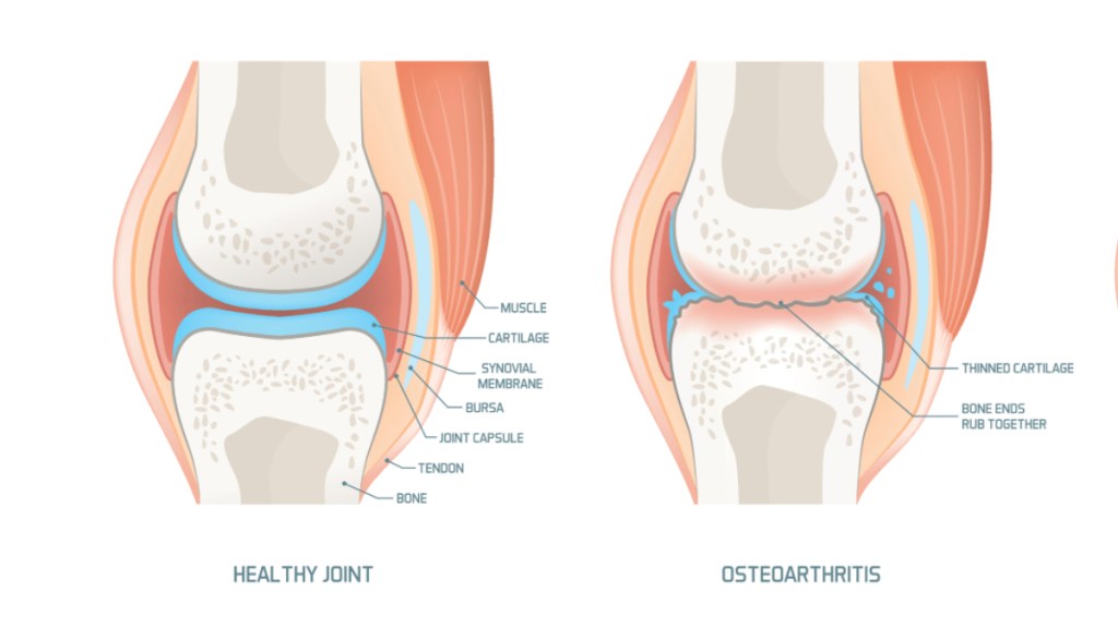An illustration of arthritis, which can be managed with self-care