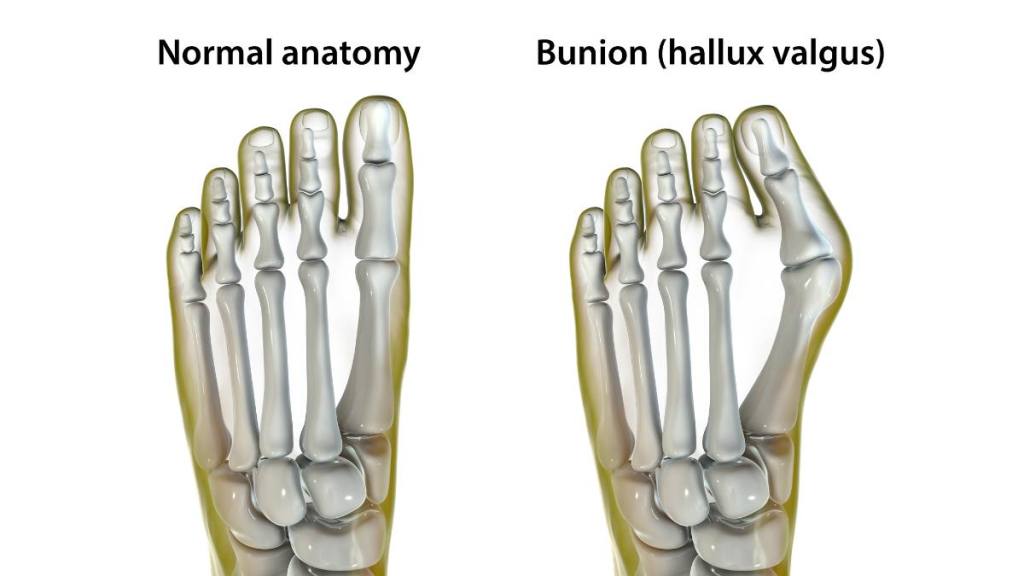 bunion exercises: Hallux valgus, also known as bunion, illustration. Hallux valgus is an abnormal deviation of the big toe, which leads to a deformation at the front of the foot at the first metatarsal and the big toe