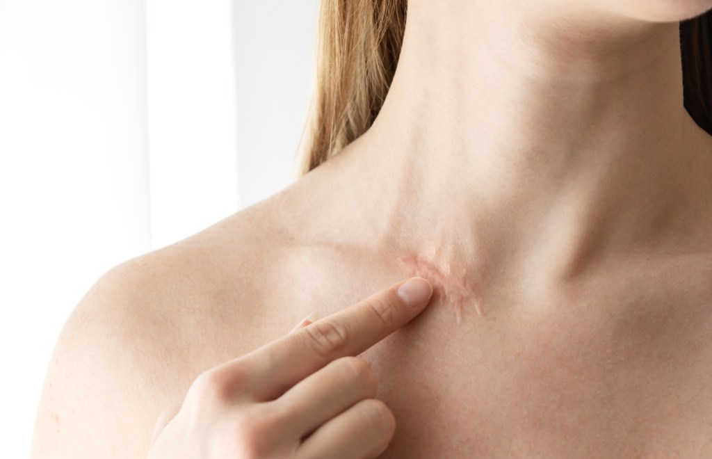 scar on woman's neck