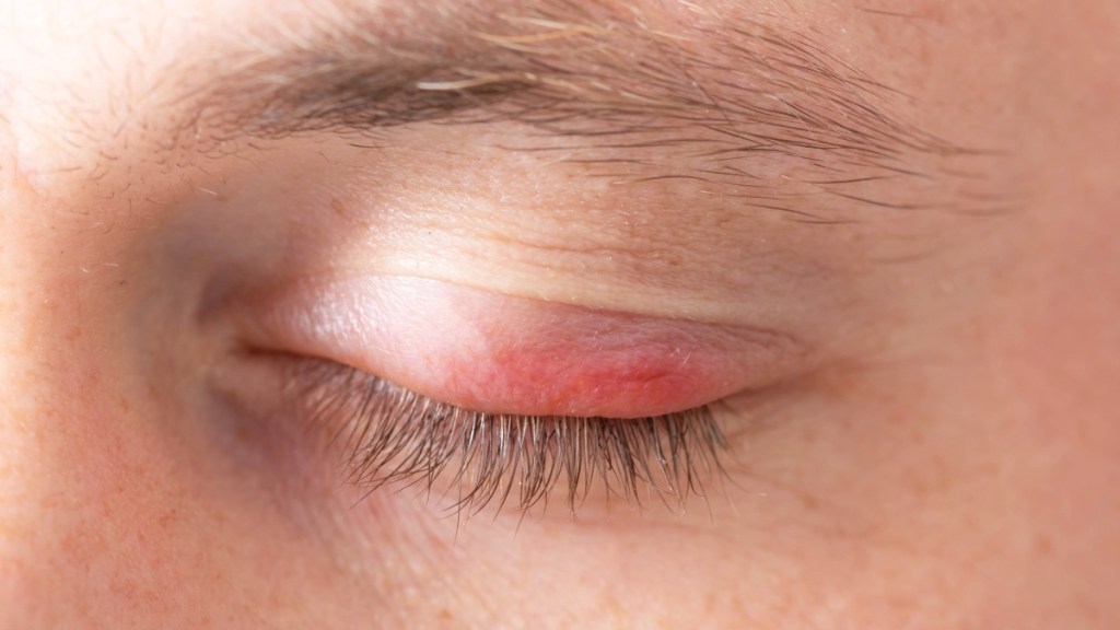 A woman with a closed, red, swollen eyelid