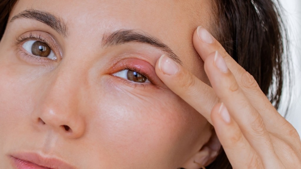 Close-up of a swollen eyelid caused by a stye