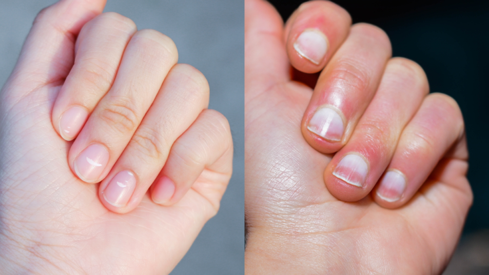 fingernail issues collage - white spots and white nail beds