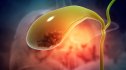 Illustration of gallbladder full of gallstones
