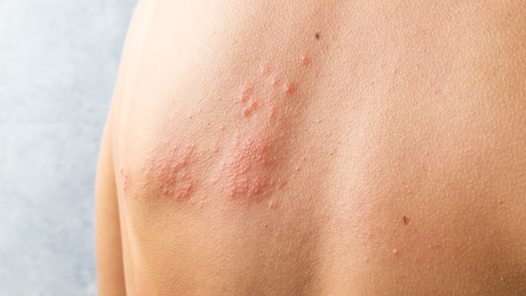 Herpes rash on back