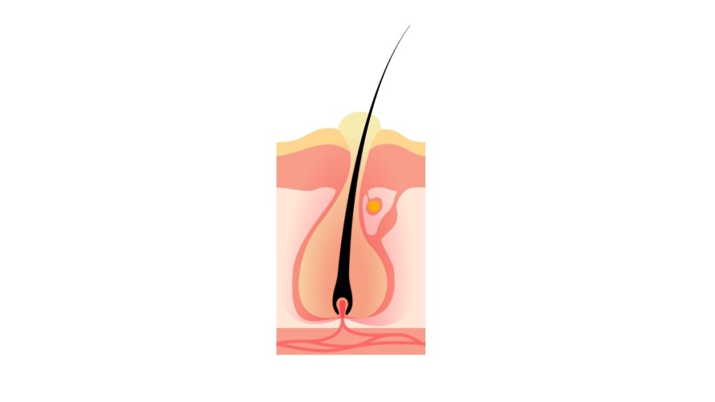 Cross section of a vaginal boil surrounding a hair follicle