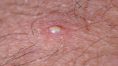 how-to-identify-and-treat-vaginal-boils-woman-s-world