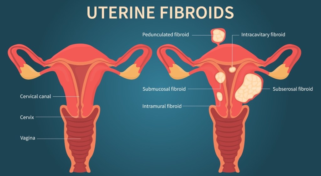 Uterine fibroids after menopause