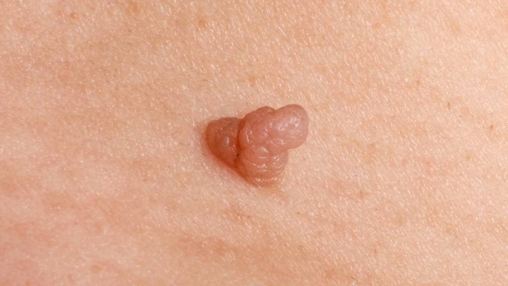 HPV wart, which can affect seniors