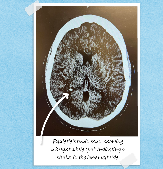 Paulette Szalay shares a brain scan showing her stroke
