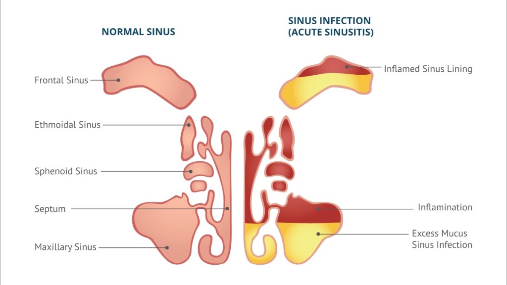 An illustration of sinusitis, or swollen and inflamed nasal cavities