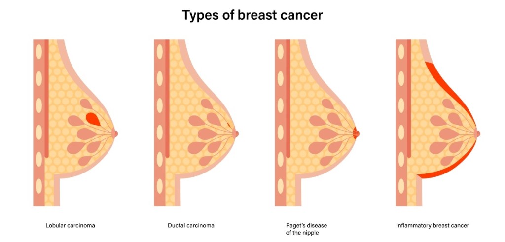 An illustration of various types of breast cancer, which can be signaled by an armpit rash