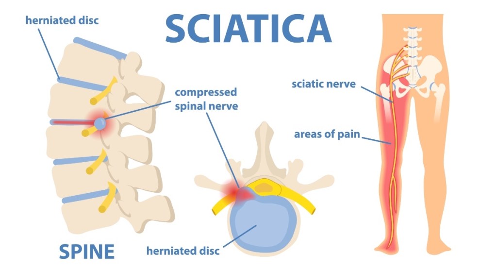An illustration of the sciatic nerve, which can cause sciatica pain that can be treated with heat or ice