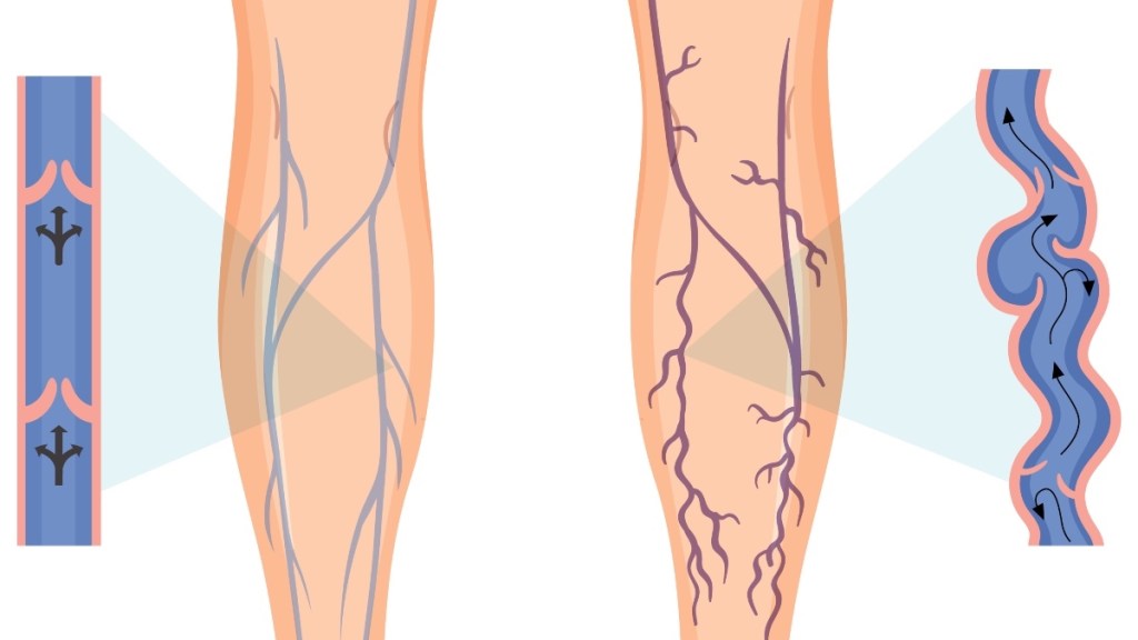An illustration of varicose veins