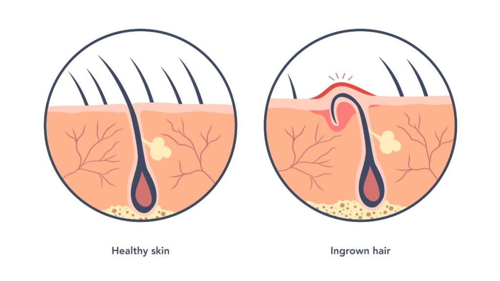 An illustration of an ingrown hair