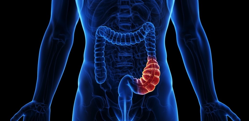 An illustration of a colon backed up with stool due to constipation, which can cause back pain