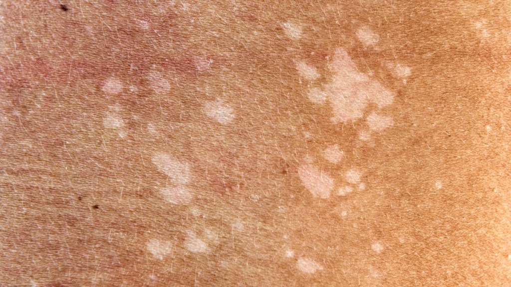 Tinea versicolor, which causes discolored white patches on skin, is not a sign of an armpit rash that signals cancer