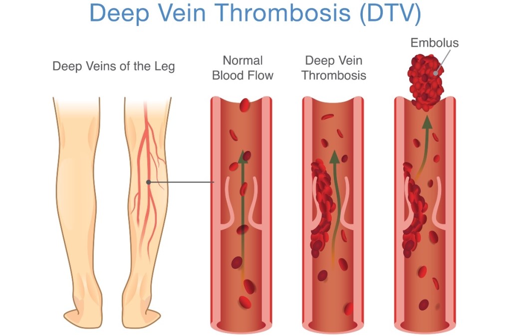 An illustration of deep vein thrombosis (DVT)