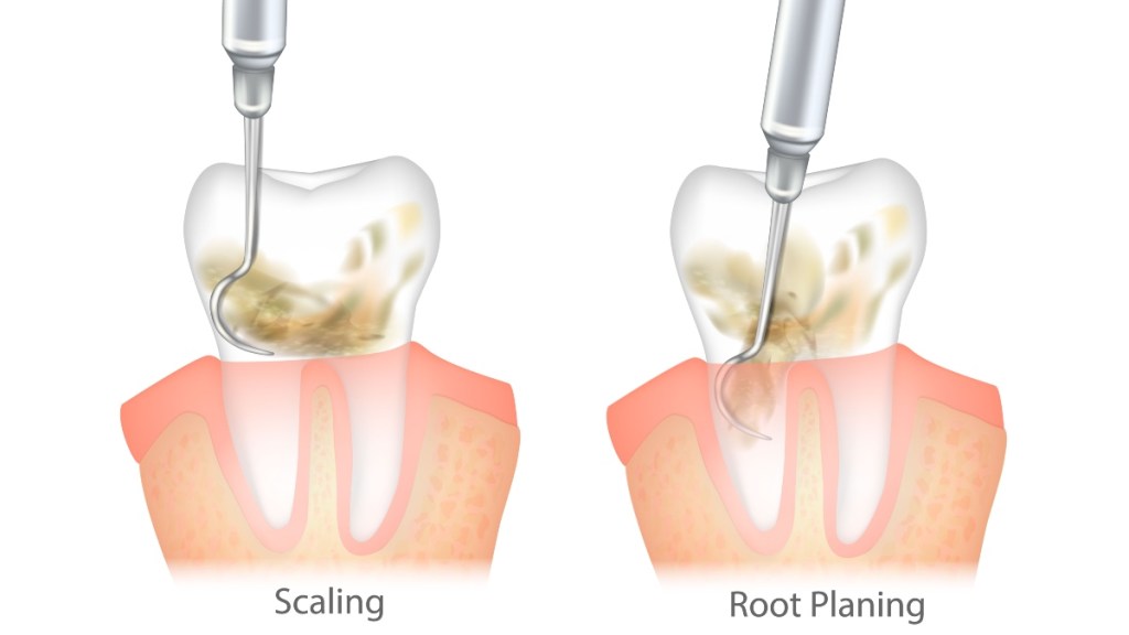 An illustration of scaling and root planing for gum disease
