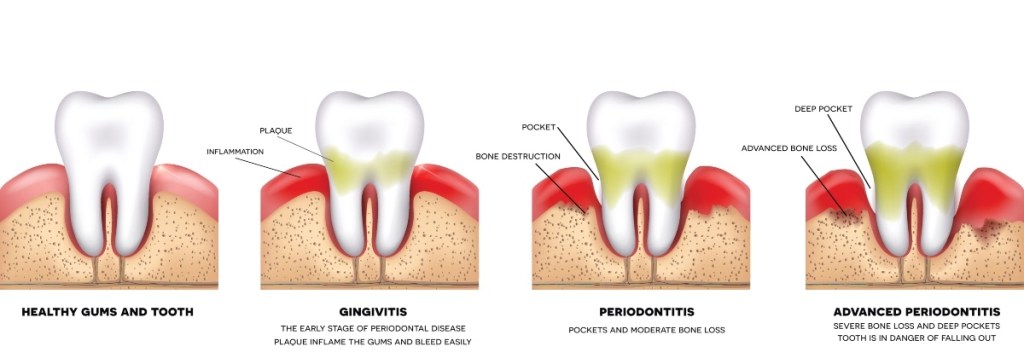 An illustration of gum disease, or gingivitis, and periodontitis