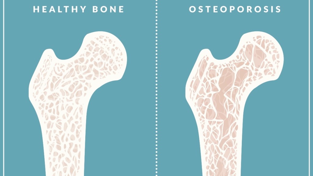 An illustration of osteoporosis, which can be treated with drugs