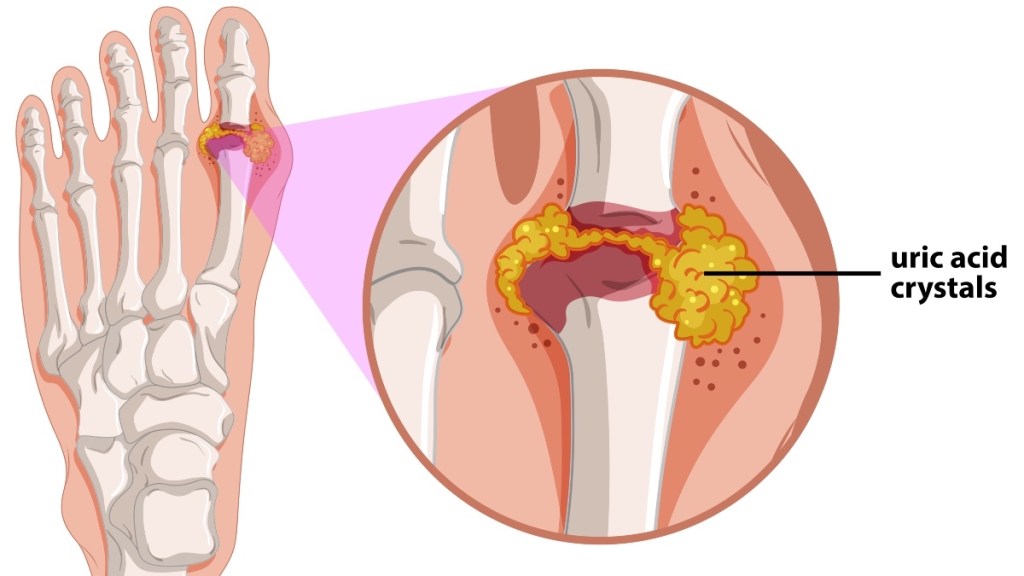 An illustration of uric acid crystals in joint, which causes gout pain