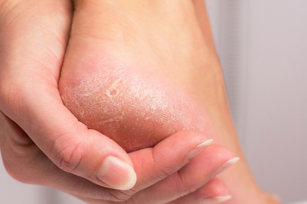 Woman with dry, cracked heel and calluses on feet
