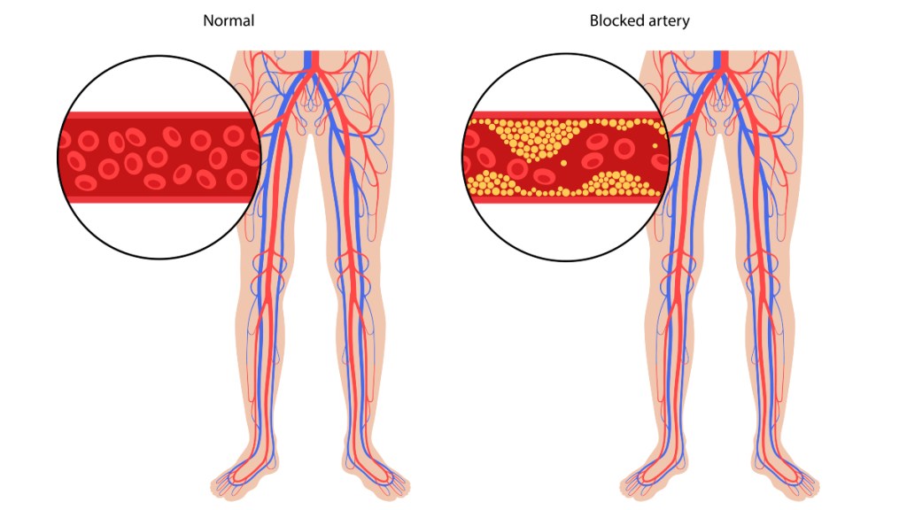 An illustration of peripheral artery disease and blocked arteries