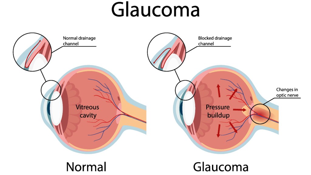 An illustration of a healthy eye and one with glaucoma