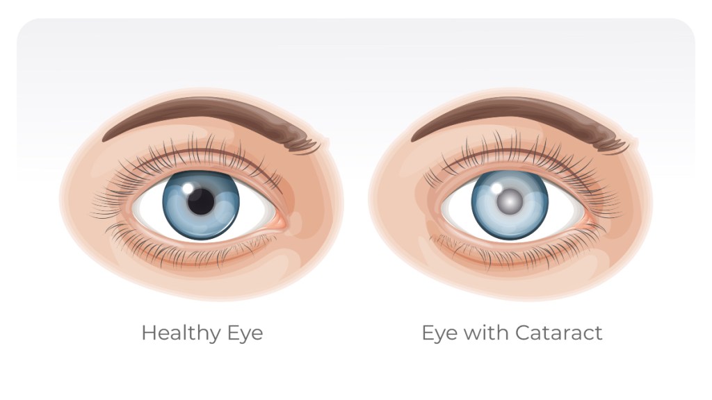 An illustration of a healthy eye and a eye clouded by cataracts