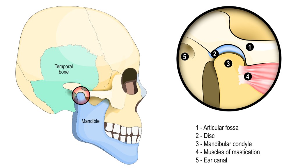 An illustration of TMJ disorder, which can cause a crackling sound in the ear