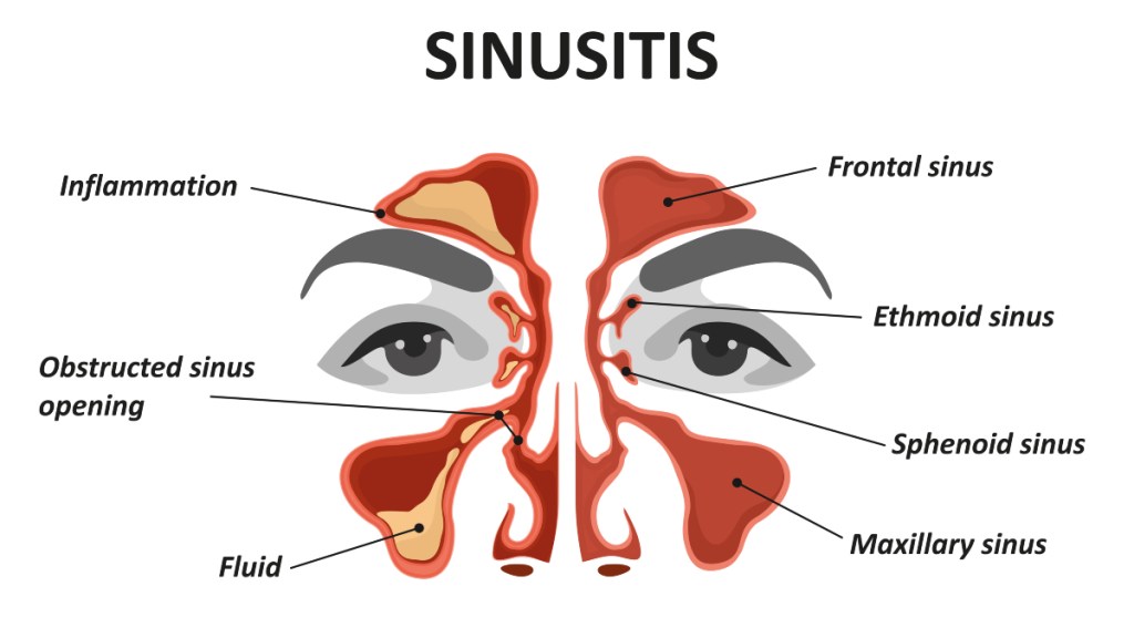 An illustration of sinusitis