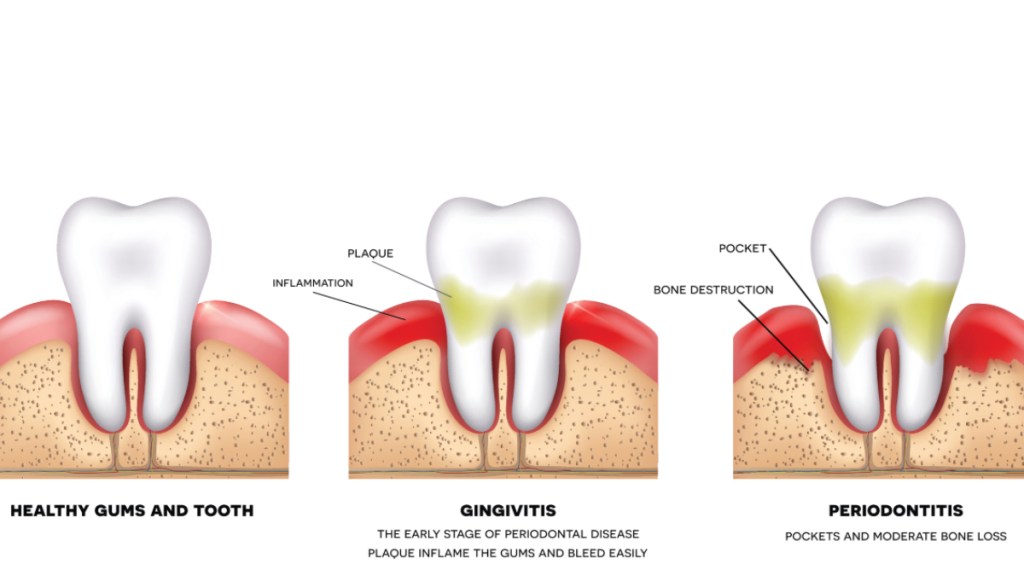 An illustration of gingivitis and periodontitis