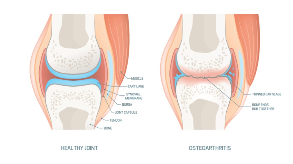 An illustration of knee osteoarthritis, which is a top cause of knee pain when bending
