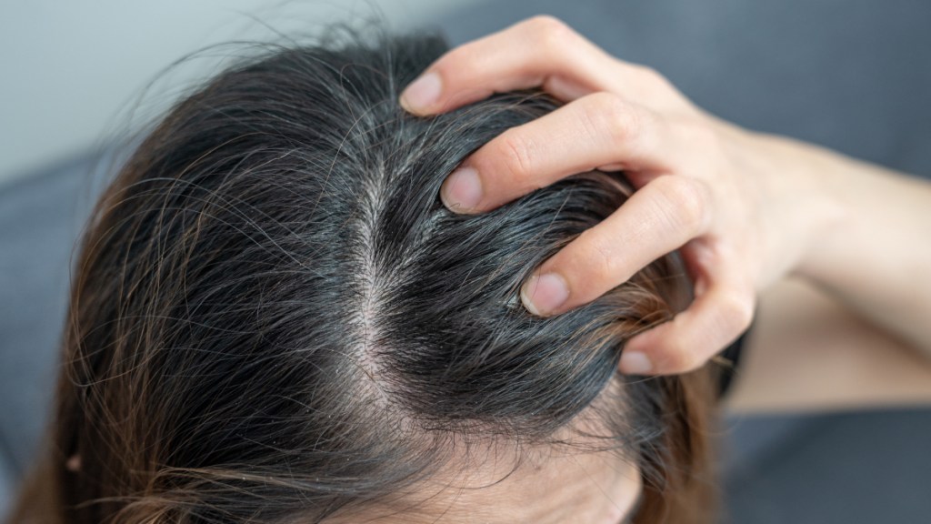 A close up of a woman's itchy scalp with dandruff