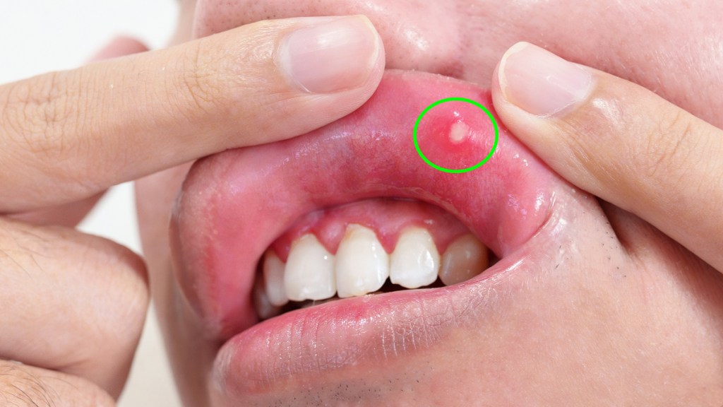 A close-up of a woman holding her lip up to reveal a canker sore she wants to get rid of fast