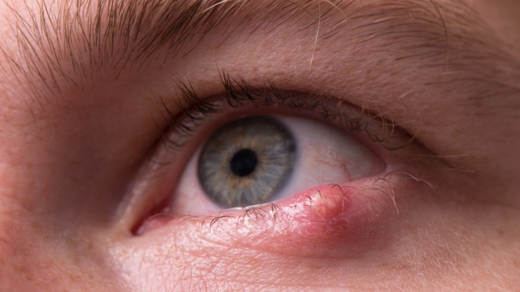 A close-up of a woman's eye with a stye