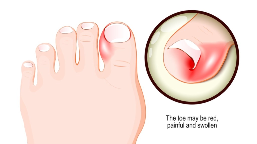 An illustration of an ingrown toenail causing redness and pain