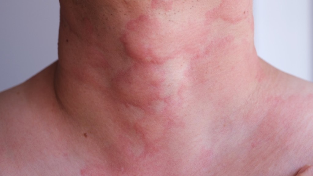 Red, raised stress hives on a person's neck